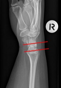 Lunate Dislocation – The Emergency Physio